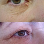 tratamiento con láser en ojo